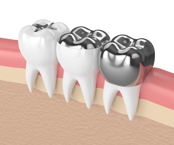 amalgam-fillings